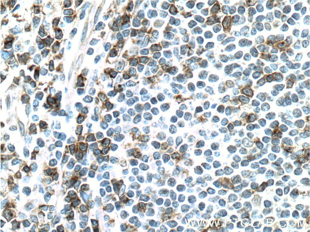 Immunohistochemistry (IHC) staining of human tonsillitis tissue using CD2 Polyclonal antibody (23973-1-AP)