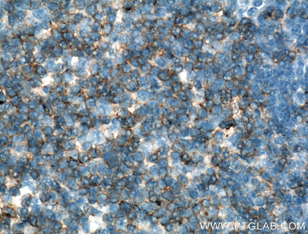 IHC staining of human tonsillitis using 60005-1-Ig