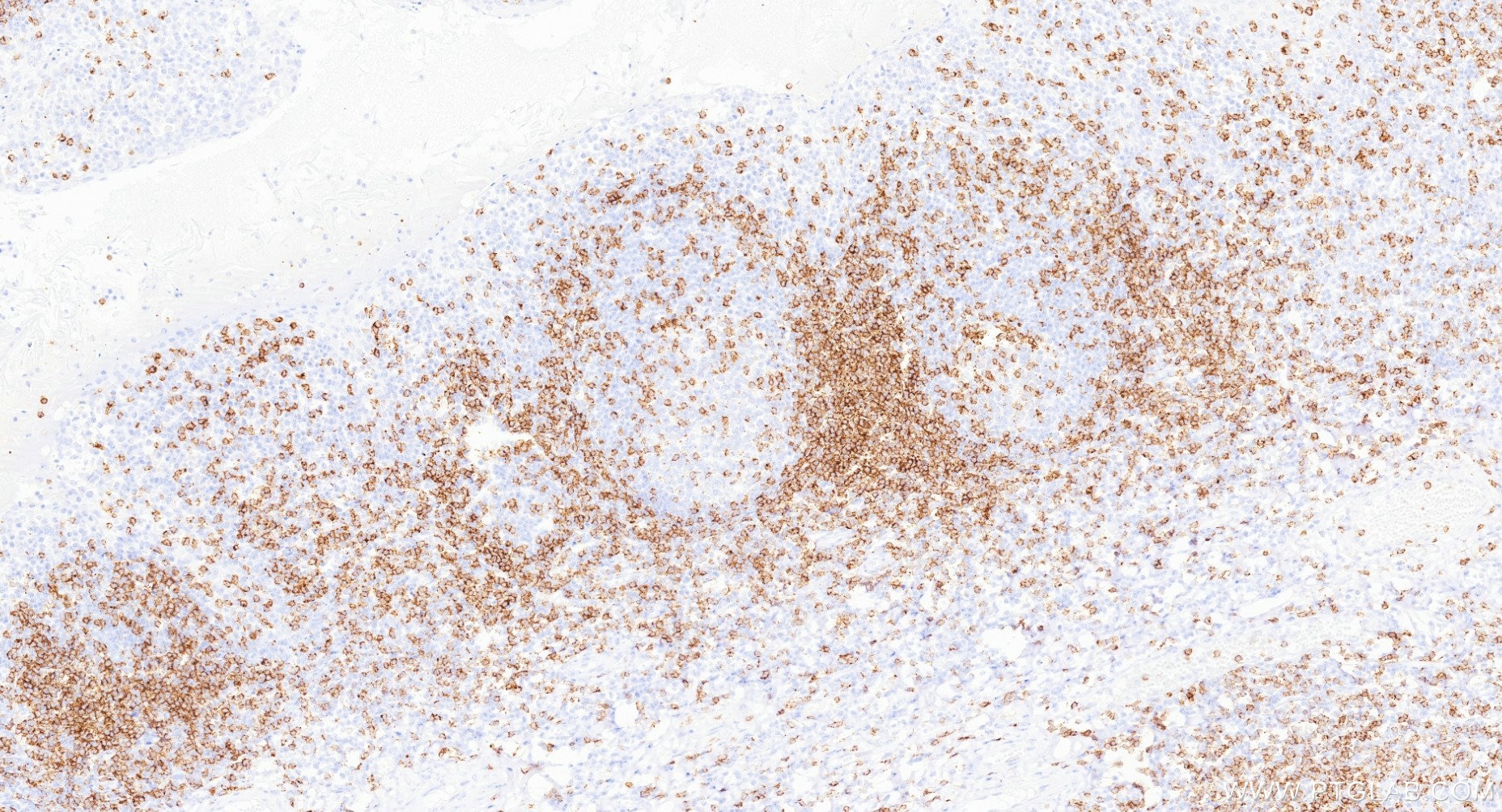 Immunohistochemistry (IHC) staining of human tonsillitis tissue using Anti-Human CD2 Rabbit Recombinant Antibody (98134-1-RR)