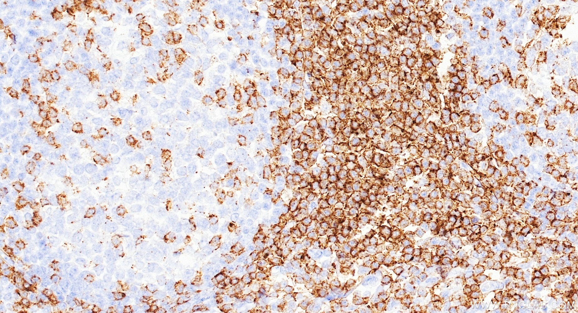 Immunohistochemistry (IHC) staining of human tonsillitis tissue using Anti-Human CD2 Rabbit Recombinant Antibody (98134-1-RR)
