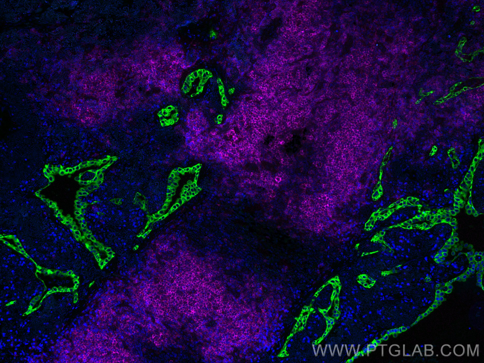 Immunofluorescence (IF) / fluorescent staining of human lung cancer tissue using CoraLite® Plus 647-conjugated CD20 Monoclonal anti (CL647-60271)