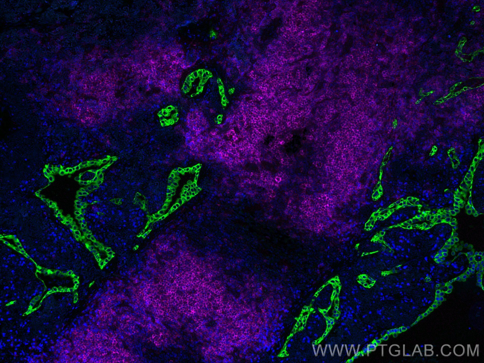 Immunofluorescence (IF) / fluorescent staining of human lung cancer tissue using CoraLite® Plus 647-conjugated CD20 Monoclonal anti (CL647-60271)