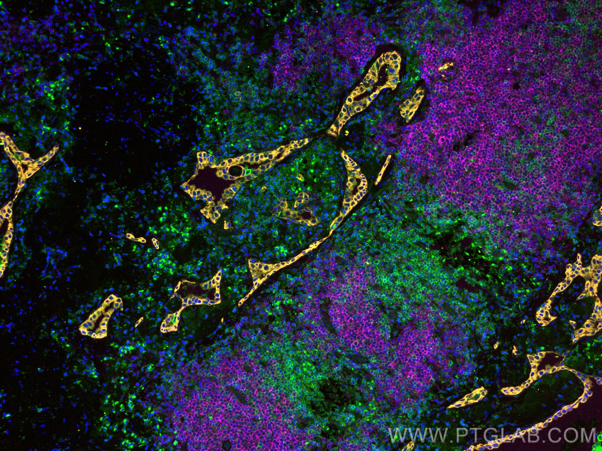 Immunofluorescence (IF) / fluorescent staining of human lung cancer tissue using CoraLite® Plus 647-conjugated CD20 Monoclonal anti (CL647-60271)