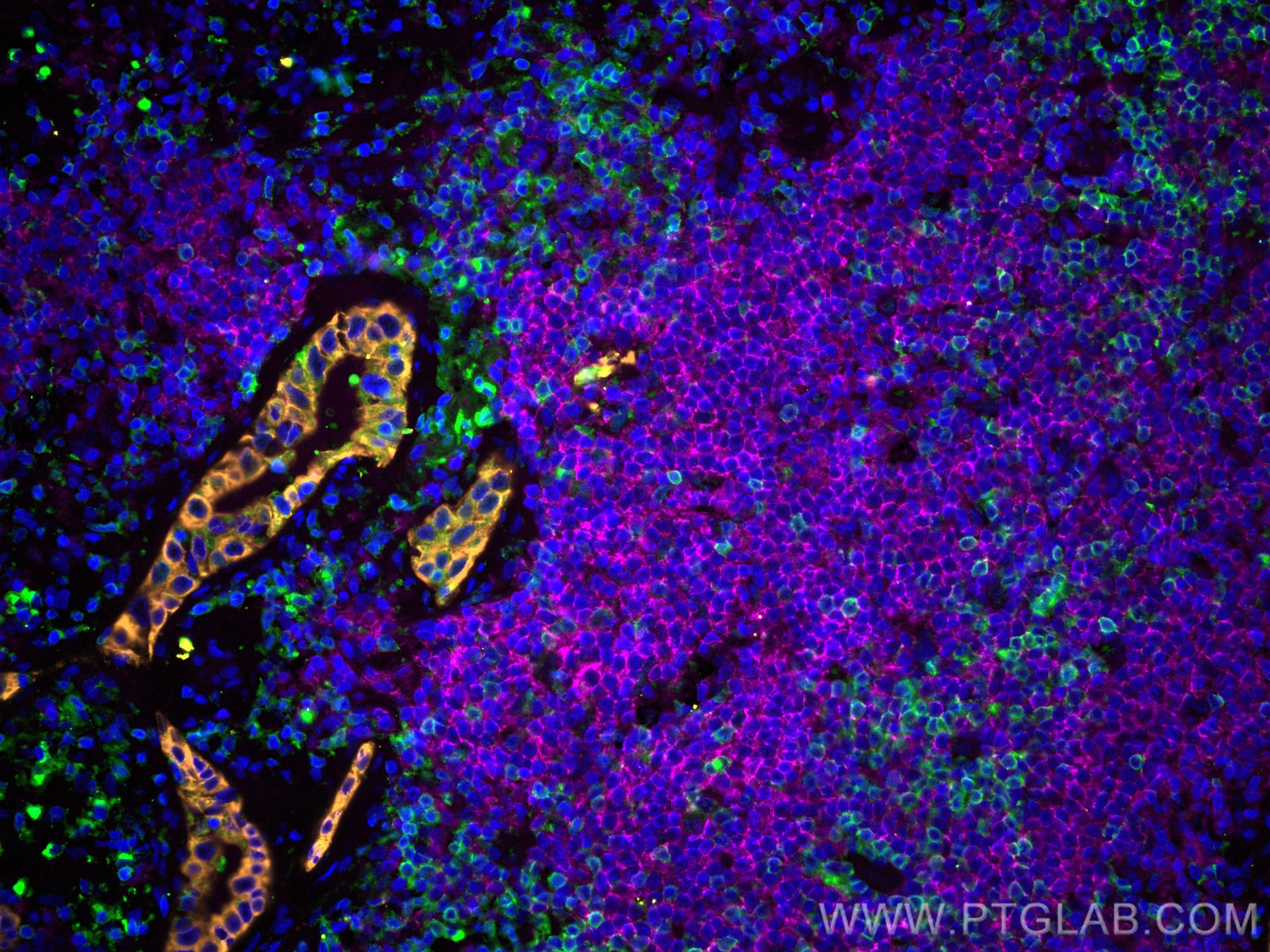 Immunofluorescence (IF) / fluorescent staining of human lung cancer tissue using CoraLite® Plus 647-conjugated CD20 Monoclonal anti (CL647-60271)