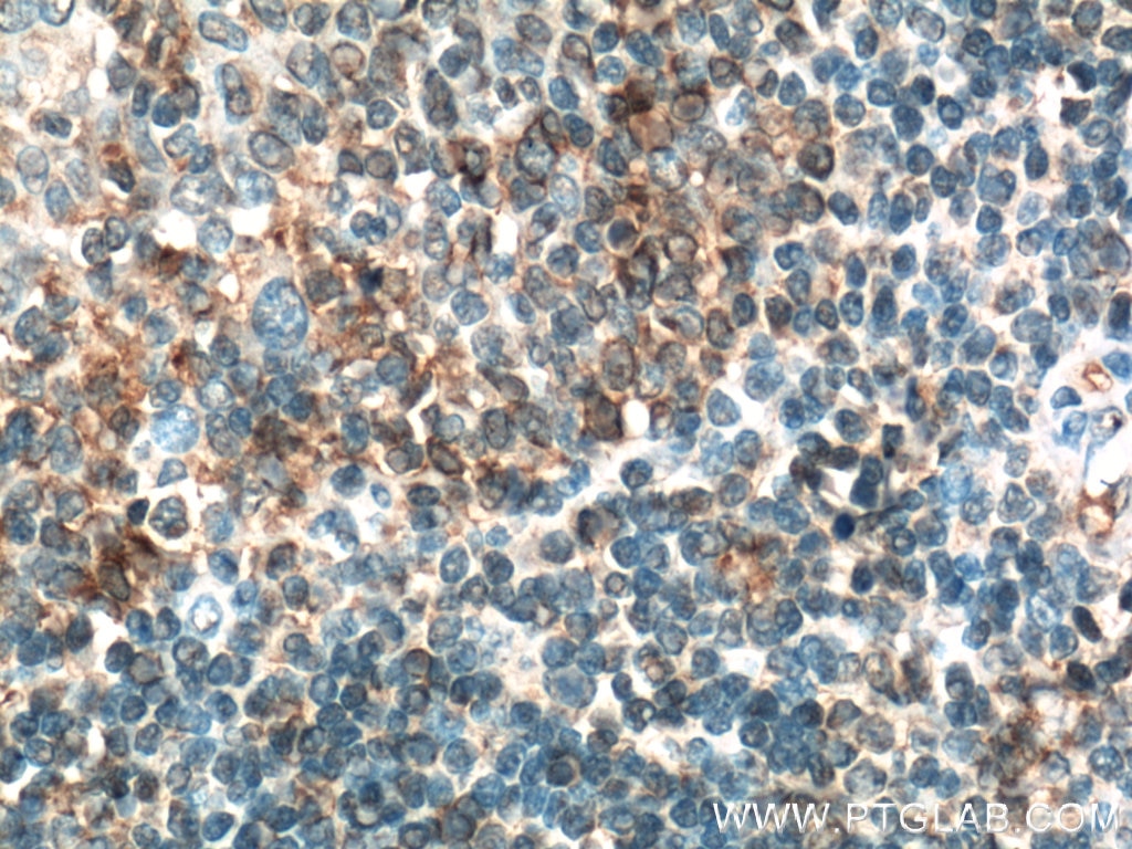 Immunohistochemistry (IHC) staining of human tonsillitis tissue using CD200 Polyclonal antibody (14057-1-AP)