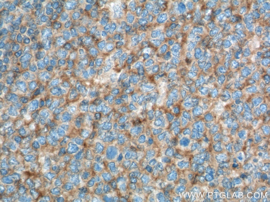 Immunohistochemistry (IHC) staining of human tonsillitis tissue using CD200 Monoclonal antibody (66282-1-Ig)
