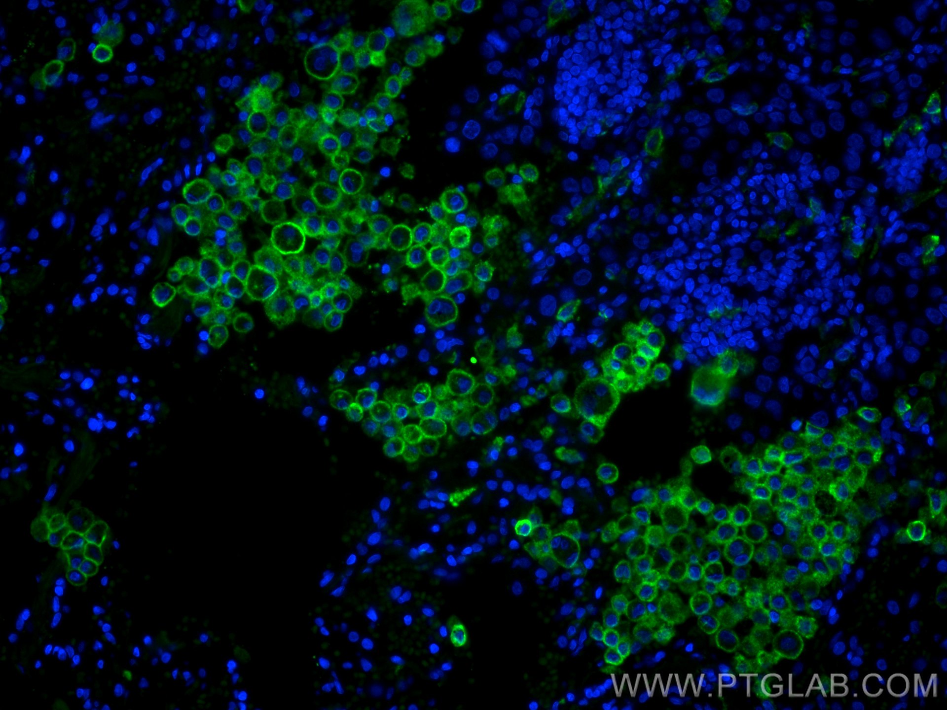 Immunofluorescence (IF) / fluorescent staining of human lung cancer tissue using CoraLite® Plus 488-conjugated CD206 Monoclonal ant (CL488-60143)