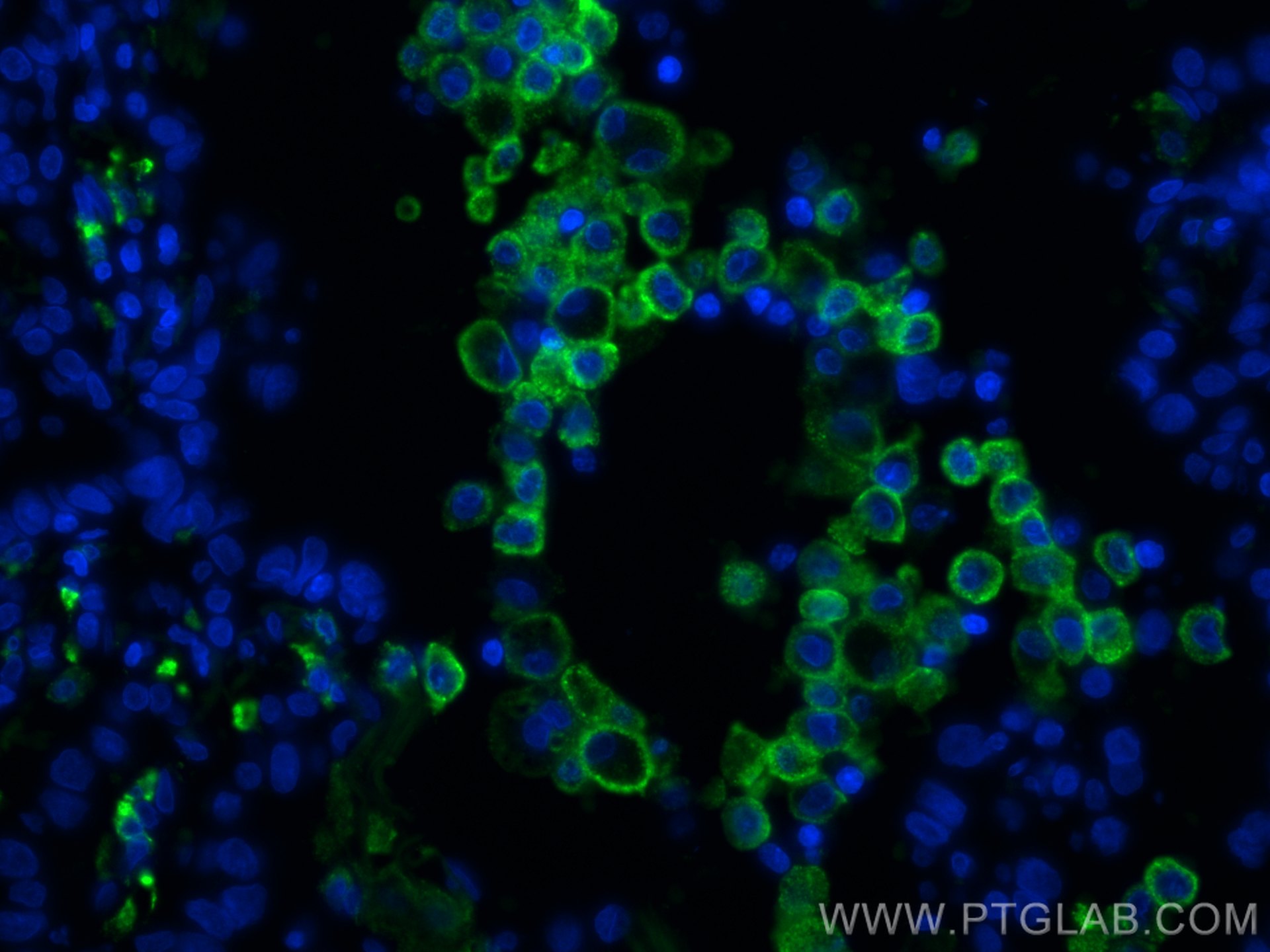 Immunofluorescence (IF) / fluorescent staining of human lung cancer tissue using CoraLite® Plus 488-conjugated CD206 Monoclonal ant (CL488-60143)