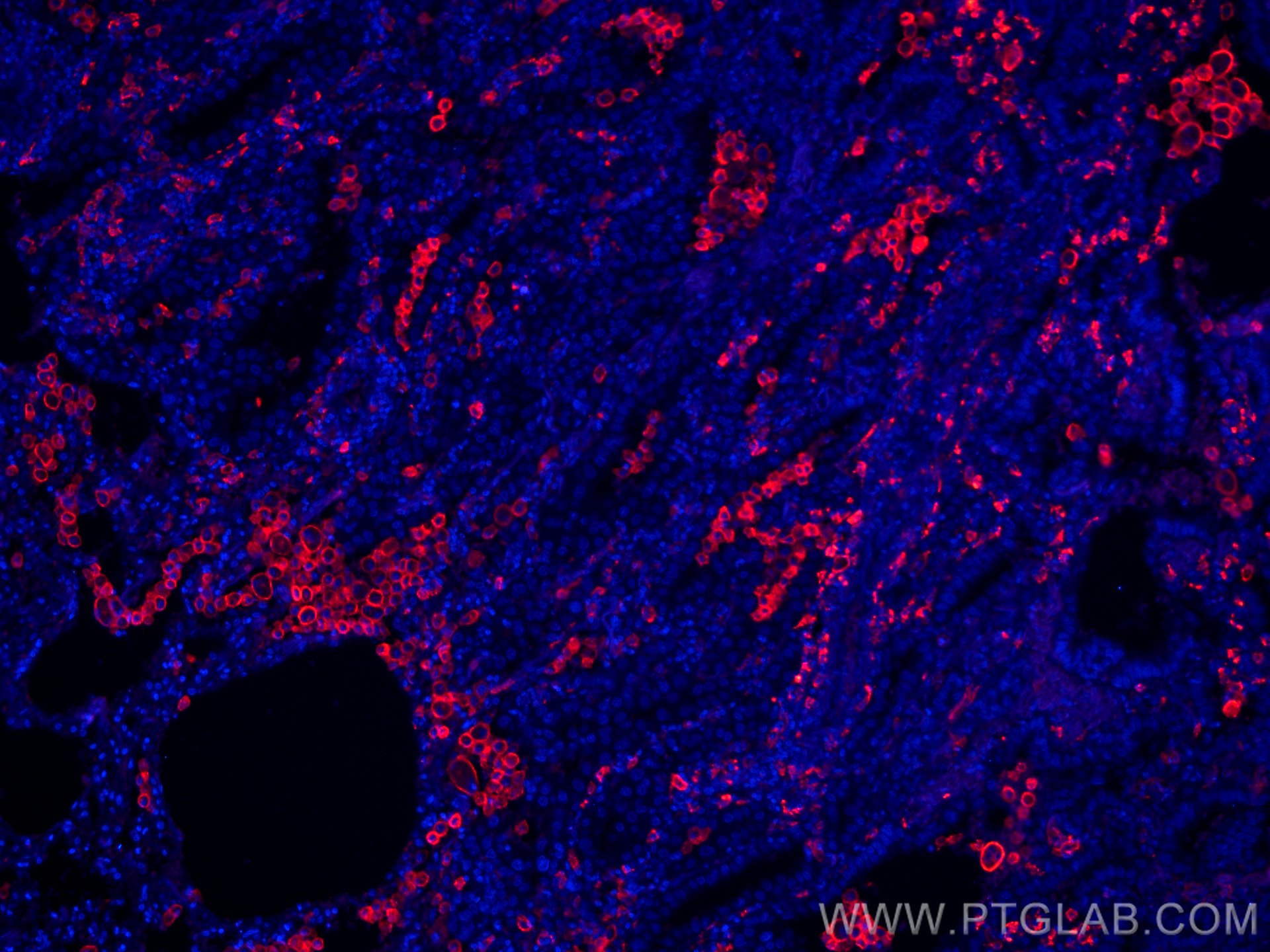 IF Staining of human lung cancer using CL594-60143