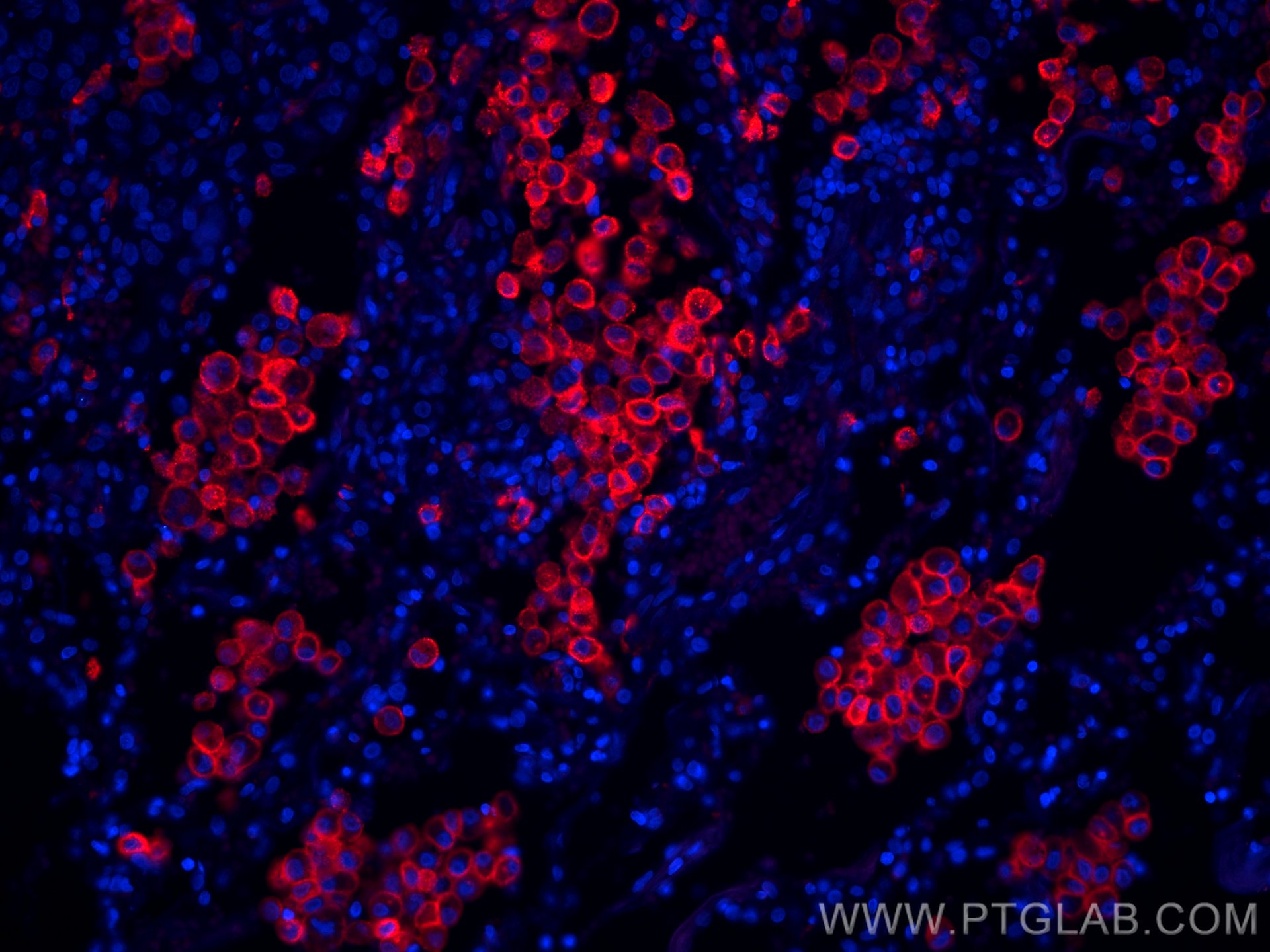 Immunofluorescence (IF) / fluorescent staining of human lung cancer tissue using CoraLite®594-conjugated CD206 Monoclonal antibody (CL594-60143)