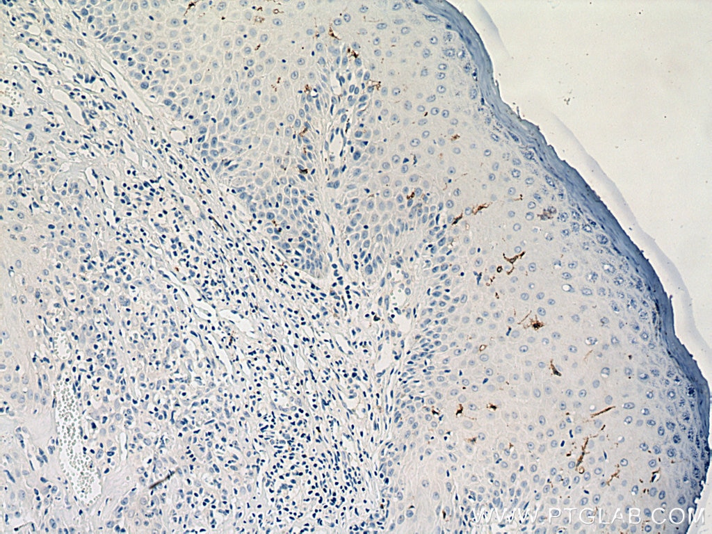 Immunohistochemistry (IHC) staining of human skin cancer tissue using Langerin Polyclonal antibody (11841-1-AP)