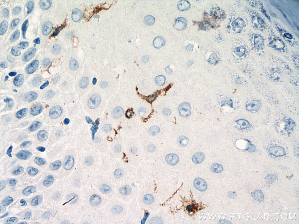 Immunohistochemistry (IHC) staining of human skin cancer tissue using Langerin Polyclonal antibody (11841-1-AP)