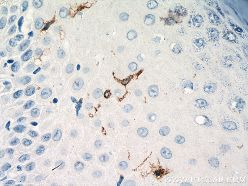 IHC staining of human skin cancer using 11841-1-AP