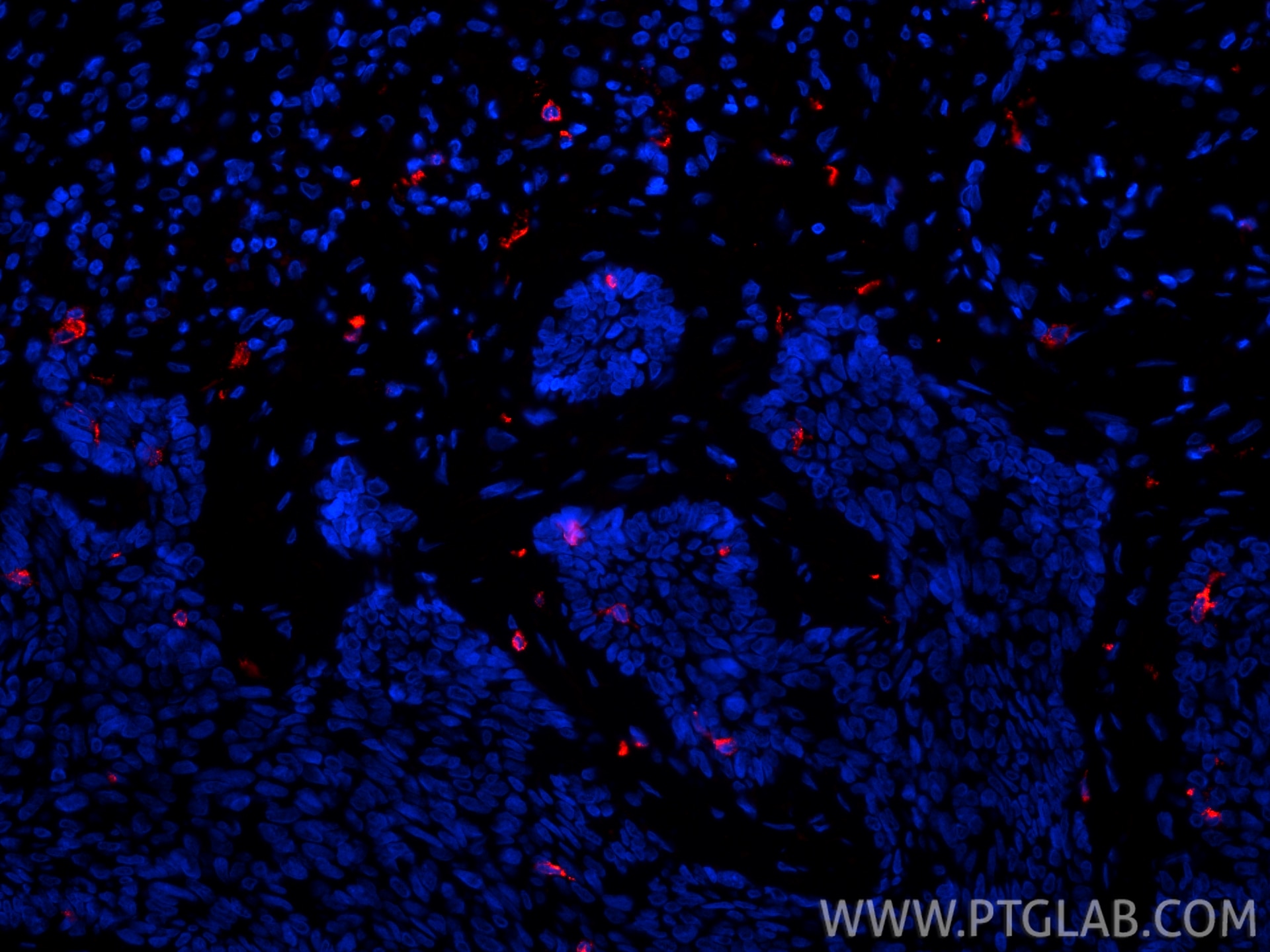 IF Staining of human skin cancer using 67788-1-Ig Immunofluorescence (IF) / fluorescent staining of human skin cancer tissue using CD207/Langerin Monoclonal antibody (67788-1-Ig)