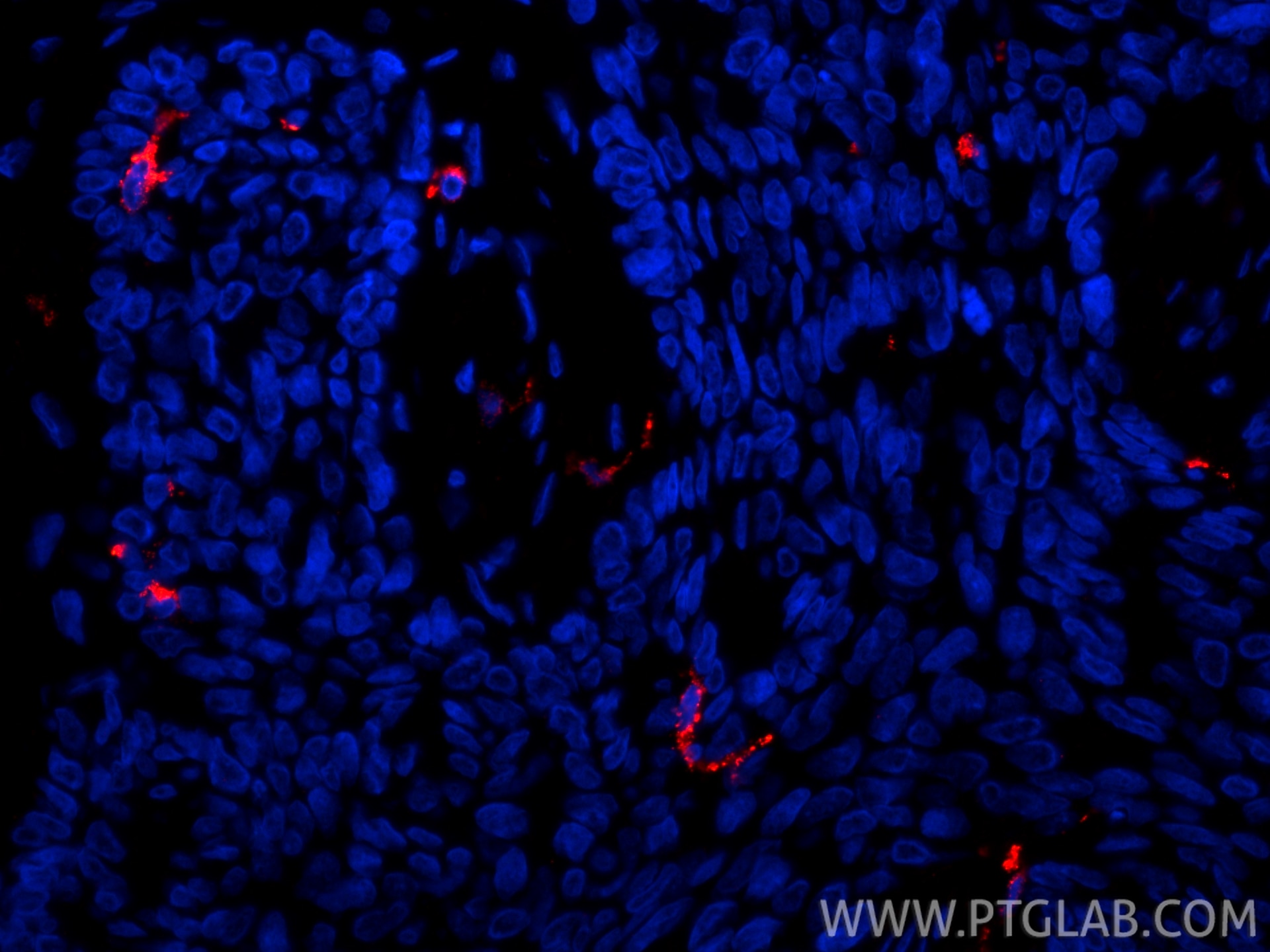 IF Staining of human skin cancer using 67788-1-Ig Immunofluorescence (IF) / fluorescent staining of human skin cancer tissue using CD207/Langerin Monoclonal antibody (67788-1-Ig)