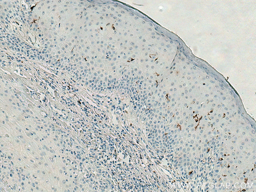 Immunohistochemistry (IHC) staining of human skin cancer tissue using CD207 Monoclonal antibody (67788-1-Ig)