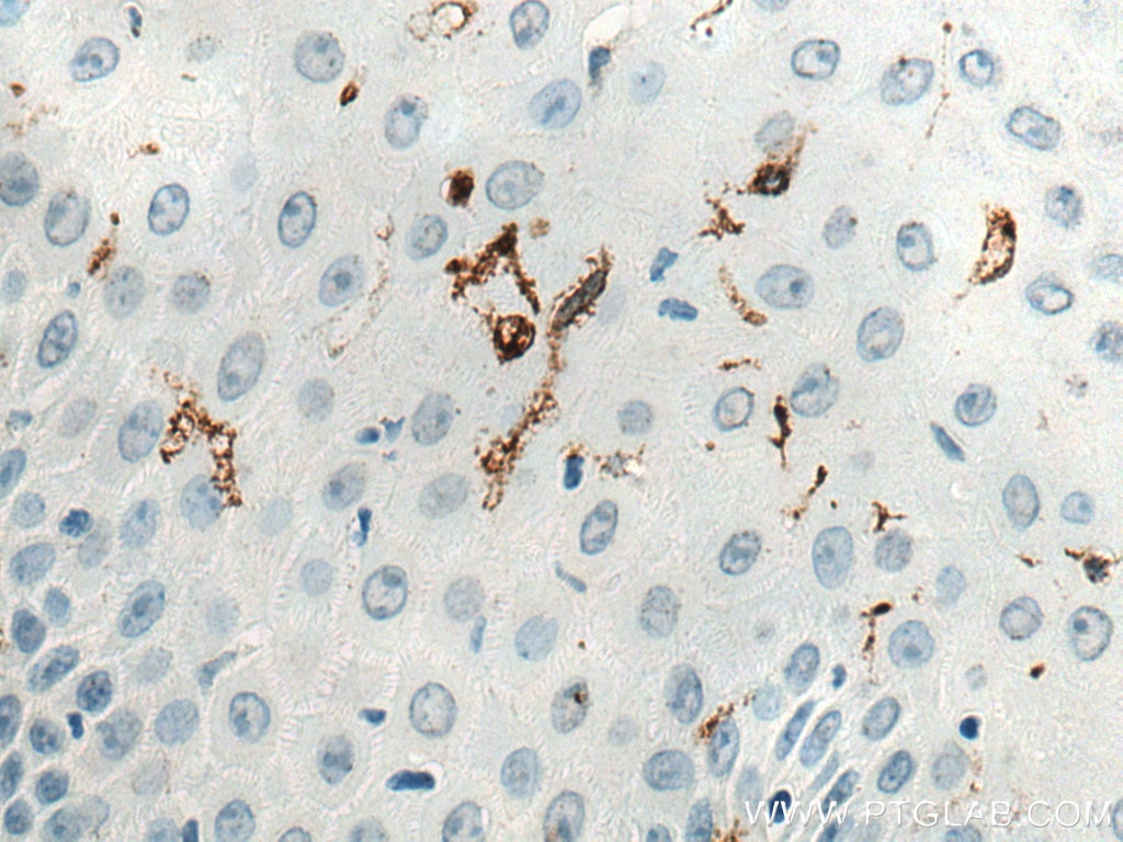 IHC staining of human skin cancer using 67788-1-Ig