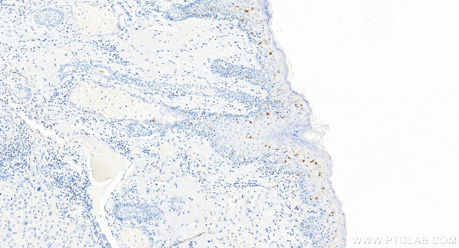IHC staining of human skin squamous cell cancer using 67788-1-Ig Immunohistochemistry (IHC) staining of human skin squamous cell cancer tissue using CD207/Langerin Monoclonal antibody (67788-1-Ig)