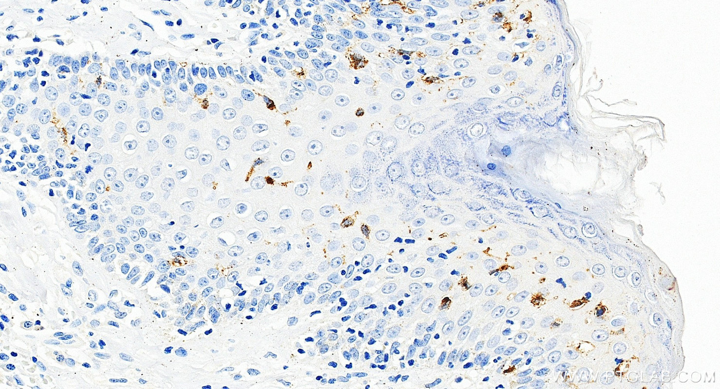 IHC staining of human skin squamous cell cancer using 67788-1-Ig Immunohistochemistry (IHC) staining of human skin squamous cell cancer tissue using CD207/Langerin Monoclonal antibody (67788-1-Ig)