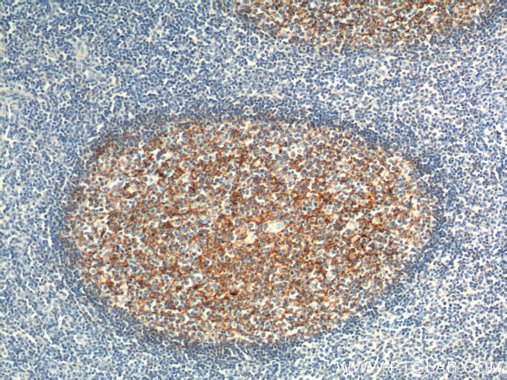 Immunohistochemistry (IHC) staining of human tonsillitis tissue using CD21 Polyclonal antibody (24374-1-AP)