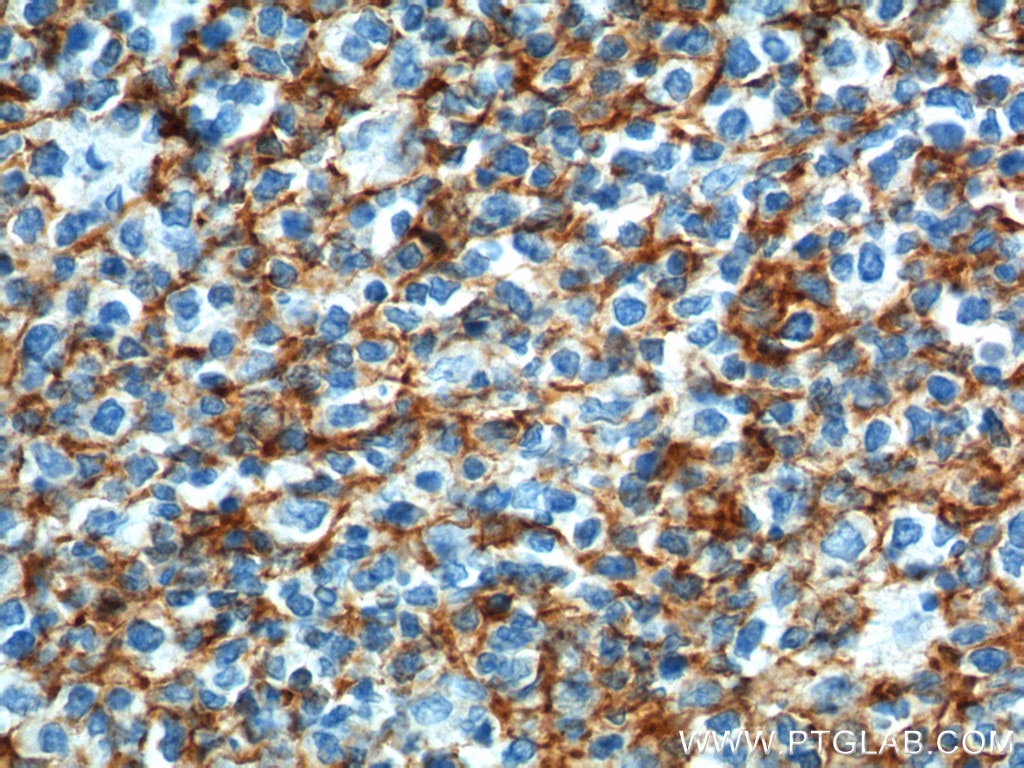 Immunohistochemistry (IHC) staining of human tonsillitis tissue using CD21 Polyclonal antibody (24374-1-AP)