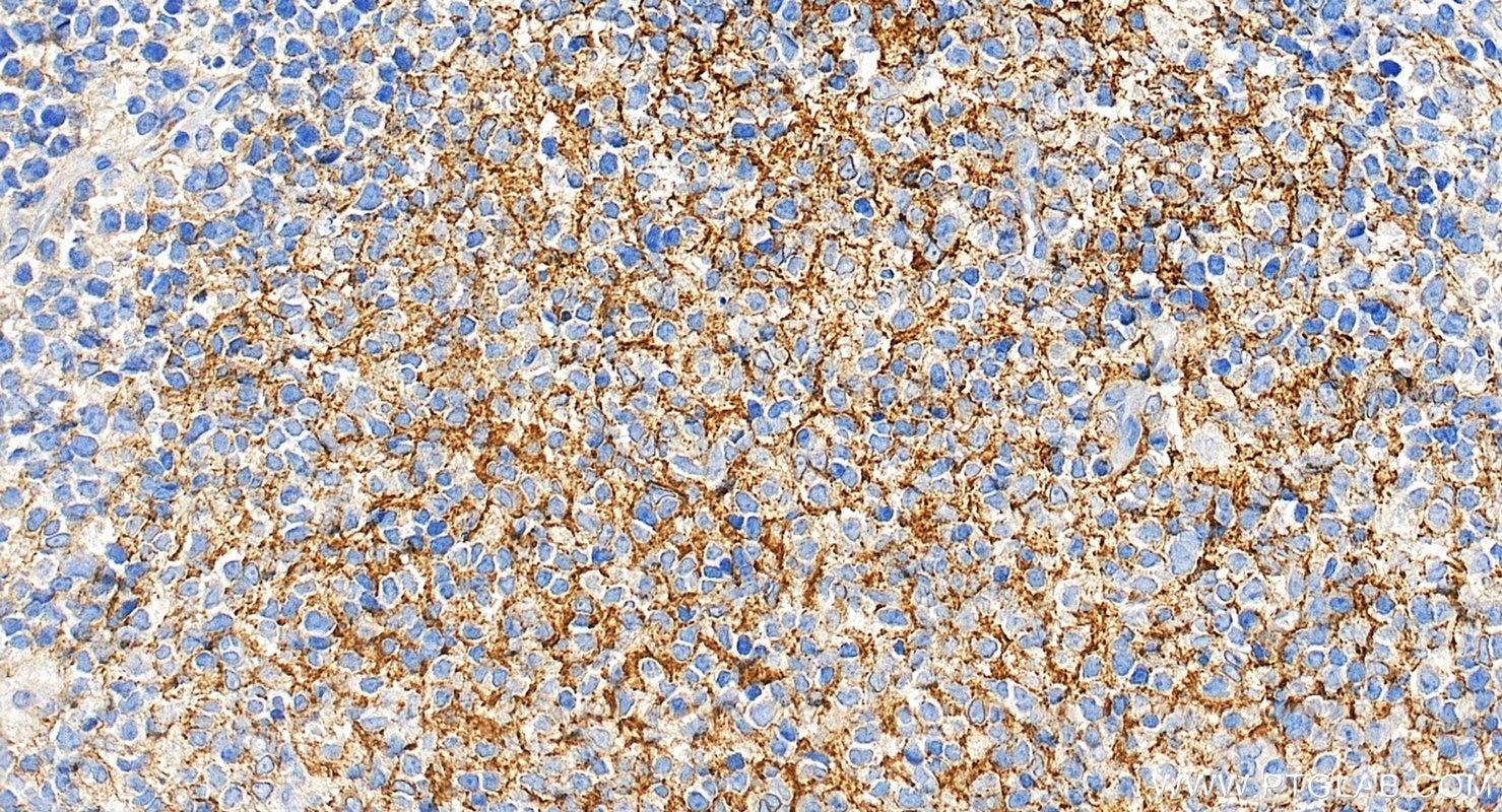 Immunohistochemical analysis of paraffin-embedded human tonsillitis tissue slide using 87097-1-RR (CD21 antibody) at dilution of 1:200 (under 20x lens). Heat mediated antigen retrieval with Tris-EDTA buffer (pH 9.0). This data was developed using the same antibody clone with 87097-1-PBS in a different storage buffer formulation. Immunohistochemistry (IHC) staining of human tonsillitis tissue using CD21 Recombinant monoclonal antibody (87097-1-RR)