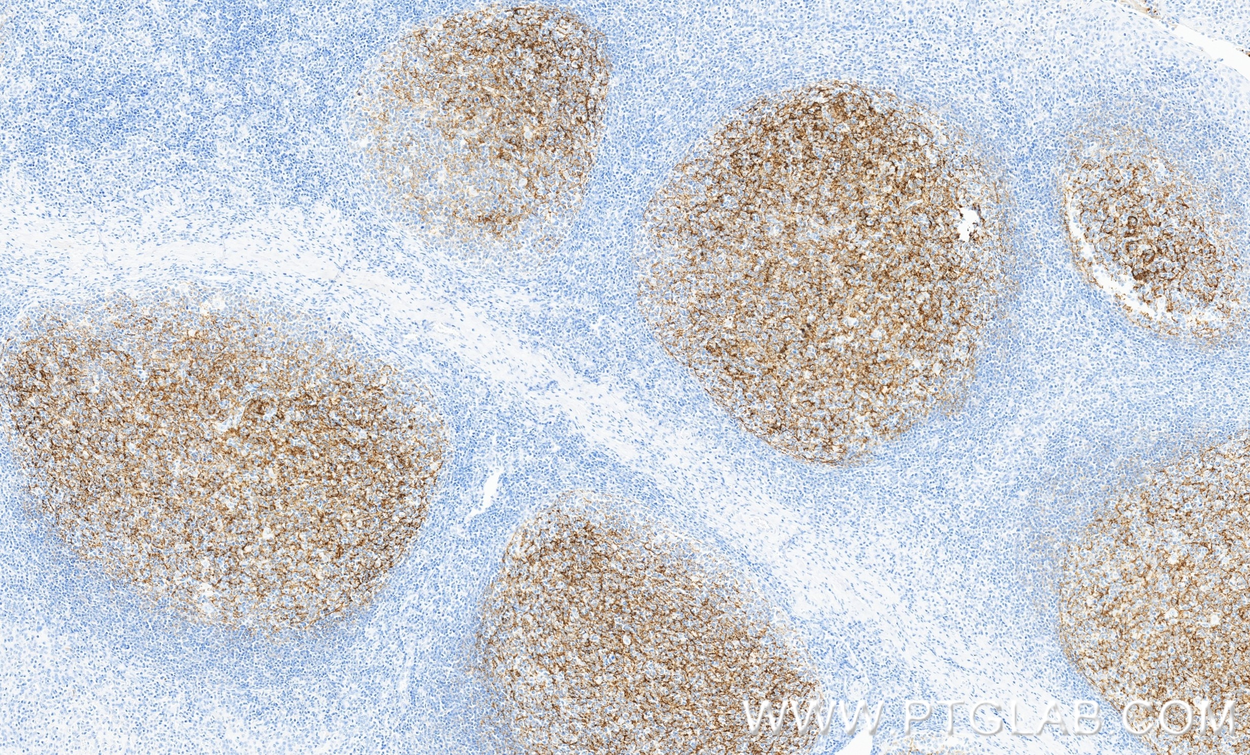 Immunohistochemistry (IHC) staining of human tonsillitis tissue using CD21 Recombinant monoclonal antibody (87097-5-RR)