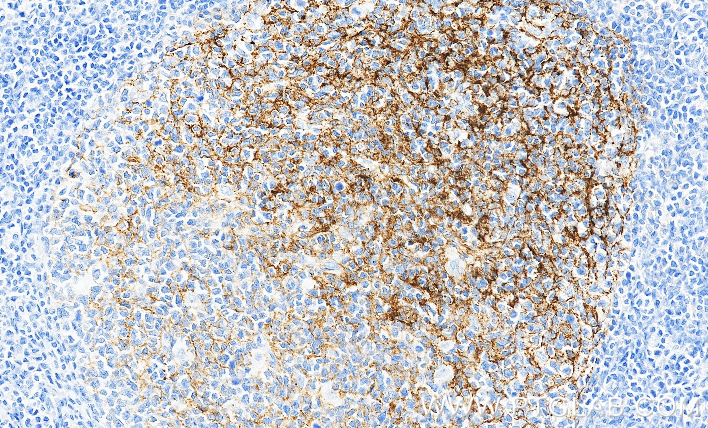 Immunohistochemistry (IHC) staining of human tonsillitis tissue using CD21 Recombinant monoclonal antibody (87097-5-RR)