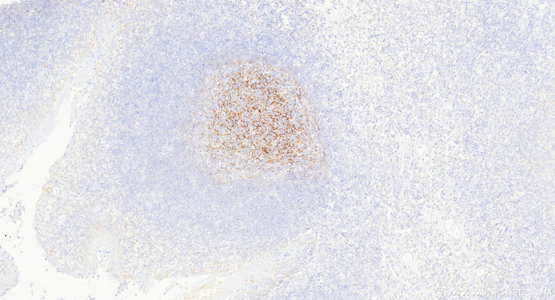 IHC staining of human tonsillitis using Biotin-87097-5 Immunohistochemistry (IHC) staining of human tonsillitis tissue using Biotin-conjugated CD21 Recombinant monoclonal anti (Biotin-87097-5)