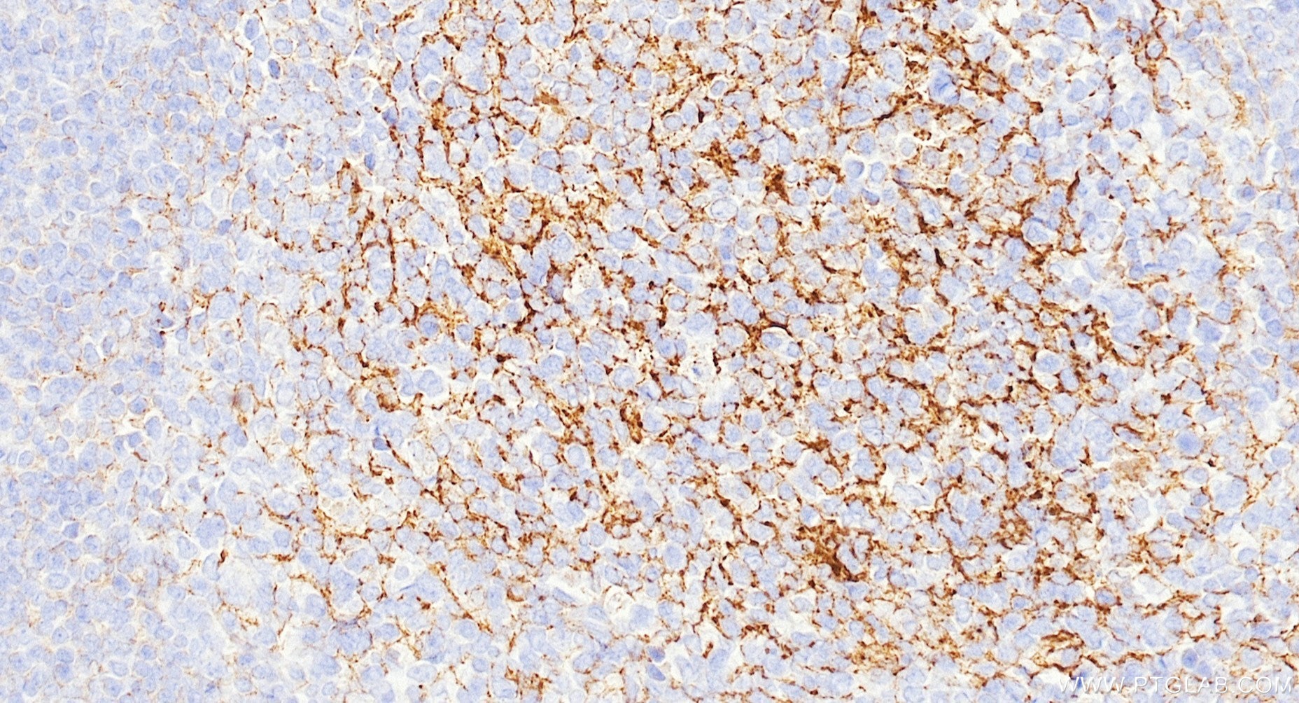 IHC staining of human tonsillitis using Biotin-87097-5 Immunohistochemistry (IHC) staining of human tonsillitis tissue using Biotin-conjugated CD21 Recombinant monoclonal anti (Biotin-87097-5)
