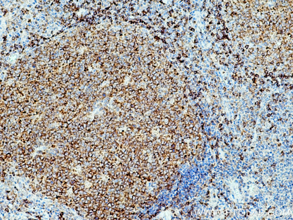 Immunohistochemistry (IHC) staining of human tonsillitis tissue using CD22 Polyclonal antibody (21894-1-AP)