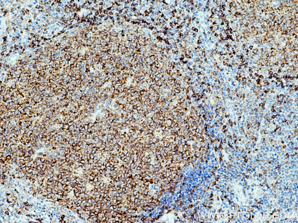 IHC staining of human tonsillitis using 21894-1-AP