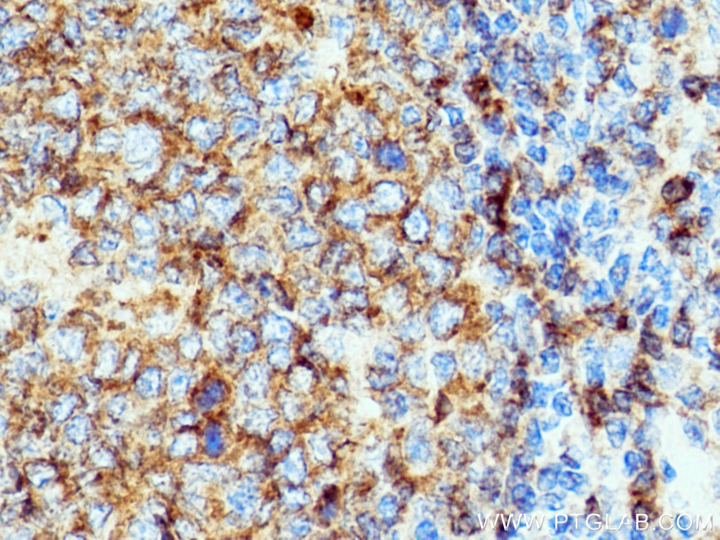 Immunohistochemistry (IHC) staining of human tonsillitis tissue using CD22 Polyclonal antibody (21894-1-AP)