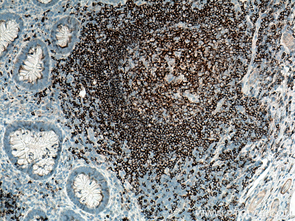 Immunohistochemistry (IHC) staining of human appendicitis tissue using CD22 Monoclonal antibody (66103-1-Ig)