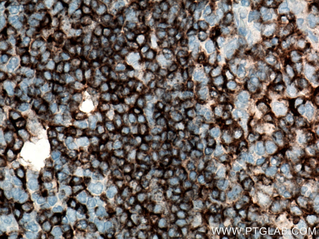 Immunohistochemistry (IHC) staining of human appendicitis tissue using CD22 Monoclonal antibody (66103-1-Ig)