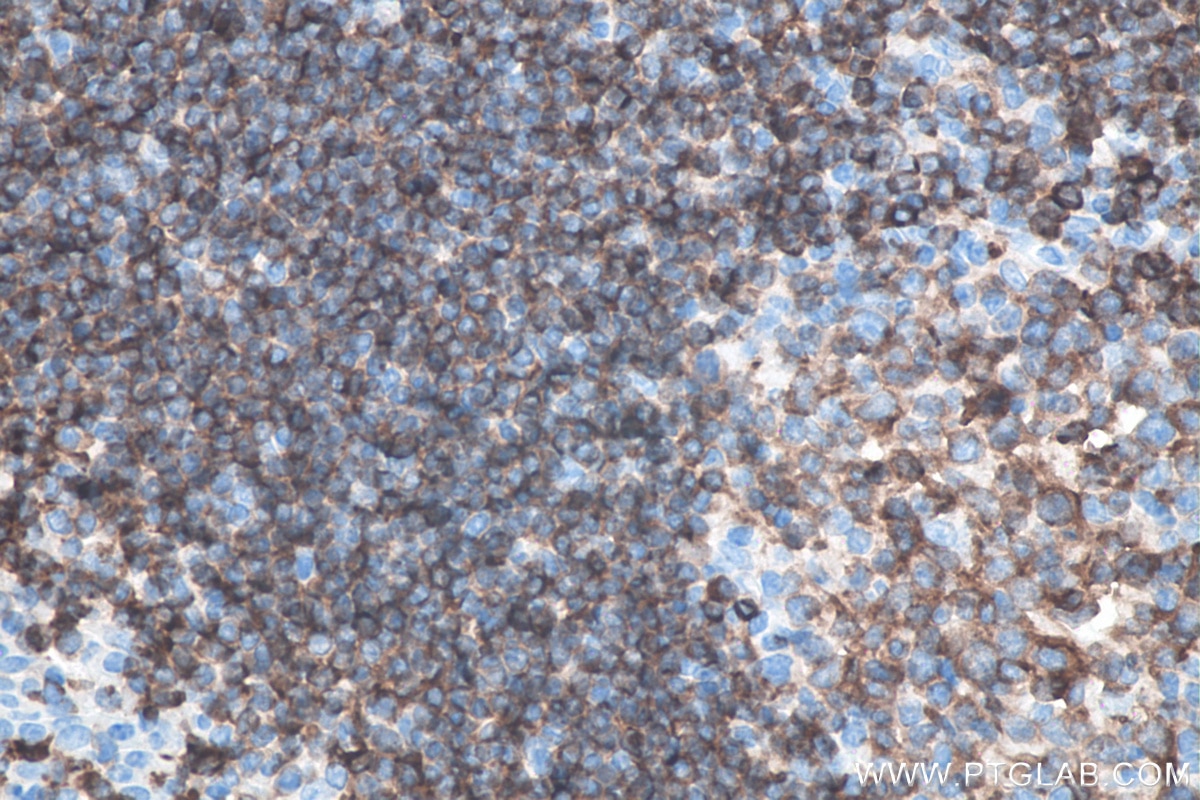 Immunohistochemistry (IHC) staining of human tonsillitis tissue using CD22 Monoclonal antibody (66103-1-Ig)