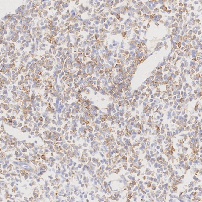 IHC staining of human lymphoma using 66103-1-Ig Immunohistochemistry (IHC) staining of human lymphoma tissue using CD22 Monoclonal antibody (66103-1-Ig)