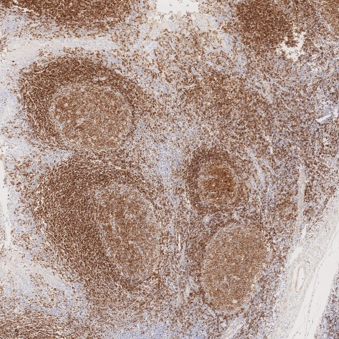 IHC staining of human tonsillitis using 66103-1-Ig Immunohistochemistry (IHC) staining of human tonsillitis tissue using CD22 Monoclonal antibody (66103-1-Ig)