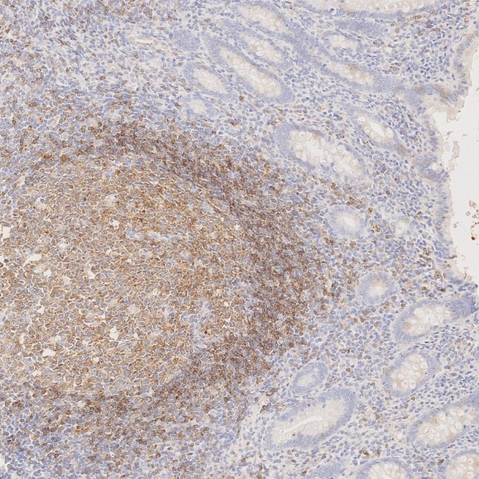 IHC staining of human appendicitis using 66103-1-Ig Immunohistochemistry (IHC) staining of human appendicitis tissue using CD22 Monoclonal antibody (66103-1-Ig)