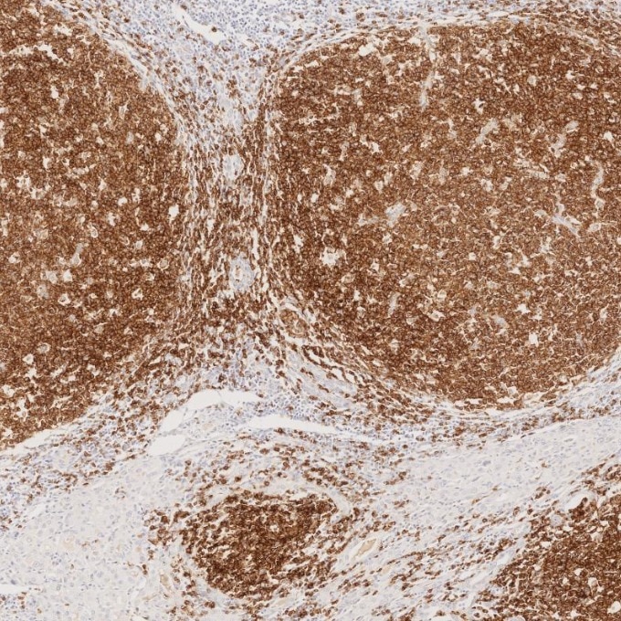 IHC staining of human lymphoma using 66103-1-Ig Immunohistochemistry (IHC) staining of human lymphoma tissue using CD22 Monoclonal antibody (66103-1-Ig)