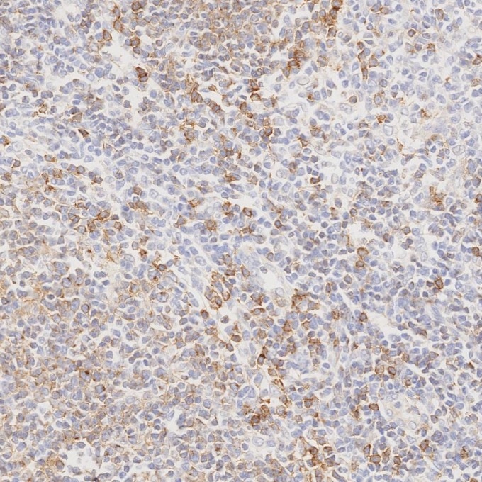 IHC staining of human lymphoma using 66103-1-Ig Immunohistochemistry (IHC) staining of human lymphoma tissue using CD22 Monoclonal antibody (66103-1-Ig)