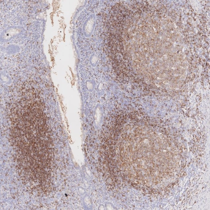 IHC staining of human appendicitis using 66103-1-Ig Immunohistochemistry (IHC) staining of human appendicitis tissue using CD22 Monoclonal antibody (66103-1-Ig)