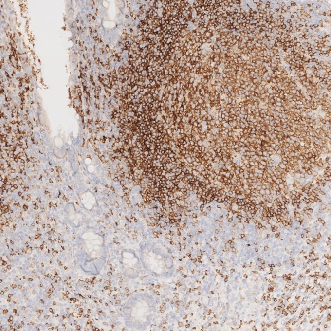 IHC staining of human appendicitis using 66103-1-Ig Immunohistochemistry (IHC) staining of human appendicitis tissue using CD22 Monoclonal antibody (66103-1-Ig)