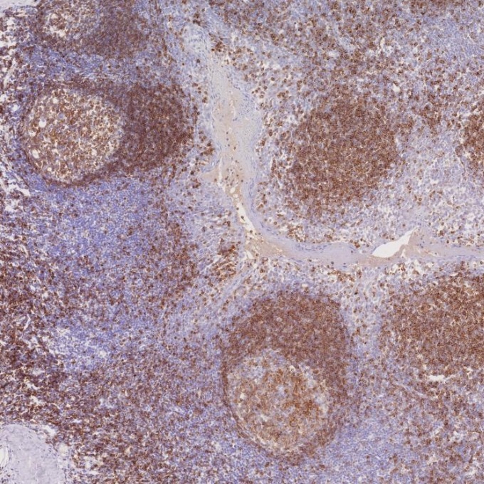 IHC staining of human tonsillitis using 66103-1-Ig Immunohistochemistry (IHC) staining of human tonsillitis tissue using CD22 Monoclonal antibody (66103-1-Ig)