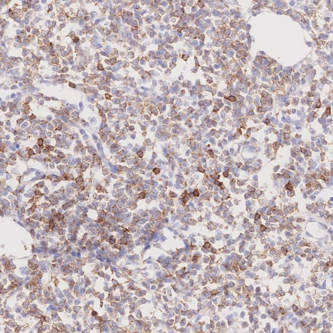 IHC staining of human lymphoma using 66103-1-Ig Immunohistochemistry (IHC) staining of human lymphoma tissue using CD22 Monoclonal antibody (66103-1-Ig)