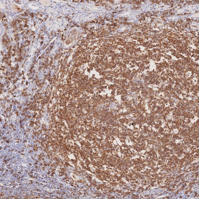 IHC staining of human lymphoma using 66103-1-Ig Immunohistochemistry (IHC) staining of human lymphoma tissue using CD22 Monoclonal antibody (66103-1-Ig)