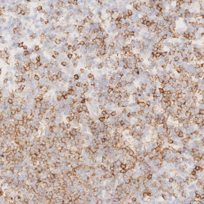 IHC staining of human lymphoma using 66103-1-Ig Immunohistochemistry (IHC) staining of human lymphoma tissue using CD22 Monoclonal antibody (66103-1-Ig)