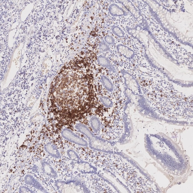 IHC staining of human lymphoma using 66103-1-Ig Immunohistochemistry (IHC) staining of human lymphoma tissue using CD22 Monoclonal antibody (66103-1-Ig)