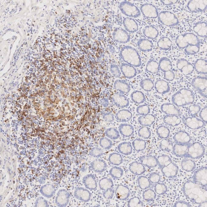 IHC staining of human lymphoma using 66103-1-Ig Immunohistochemistry (IHC) staining of human lymphoma tissue using CD22 Monoclonal antibody (66103-1-Ig)