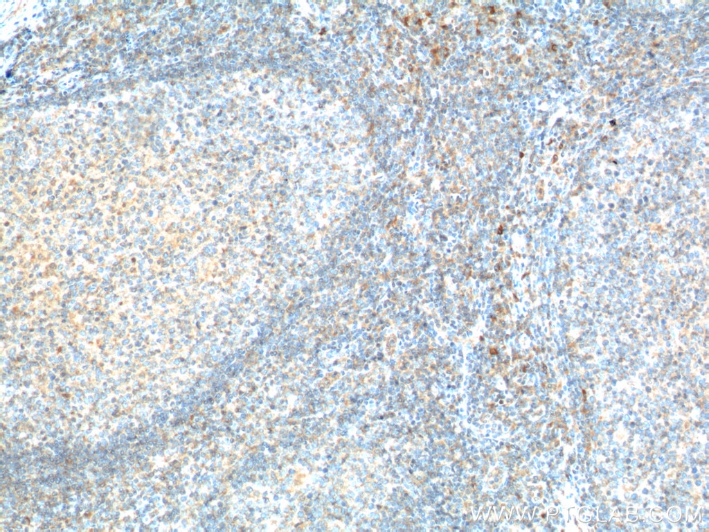 Immunohistochemistry (IHC) staining of human tonsillitis tissue using CD226 Polyclonal antibody (17842-1-AP)